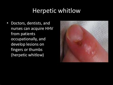 Hsv On Fingers Herpetic Whitlow Global Indian Nurses Organization