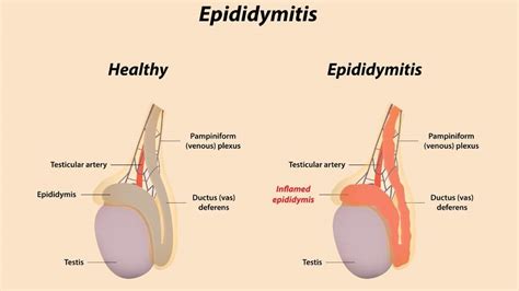 Epididymitis Symptoms Causes And Long Term Outlook 1md Nutrition