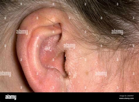 Infection And Flaking Skin Affecting A 42 Year Old Womans Outer Ear