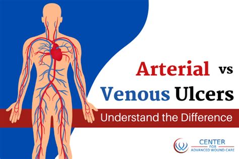 Arterial Vs Venous Ulcers Understand The Difference