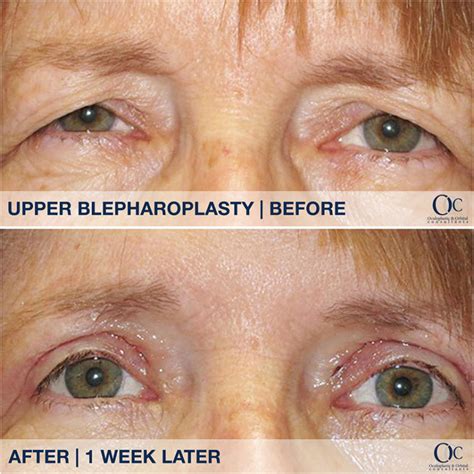 Blepharoplasty The Lunch Time Fix Oculoplastic And Orbital Consultants