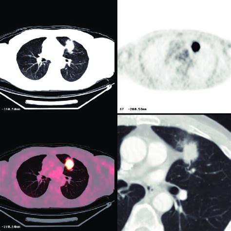 Pulmonary Nodule With Lobulated Margins Figure 6 Benign Granuloma