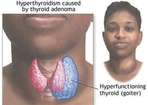 Thyrotoxicosis Personal Experiences Of Living With Thyroid Problems
