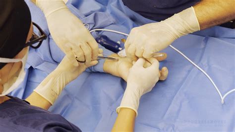 Treating Carpal Tunnel Syndrome Outside The Or Shortens Procedure And