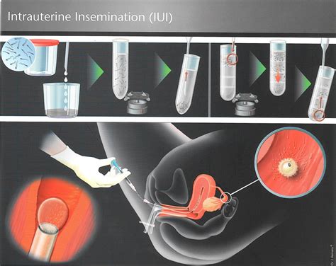 Intrauterine Insemination Iui Fertility Solutions