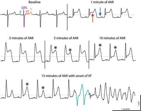 frontiers ventricular arrhythmias in first acute myocardial infarction epidemiology