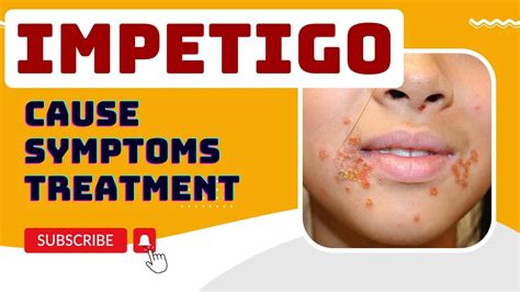 Impetigo Impetigo Skin Infection Cause Symptoms Treatment