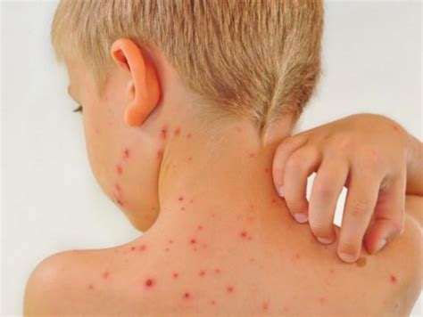 Childhood And Kids Rashes In New Paltz And Highland Firstcare Walk In