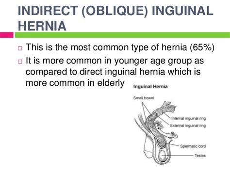 It is the most commonly used hernia treatment in modern health, used in 90. ANATOMY Of A HERNIA - Holistic Hernia Remediation