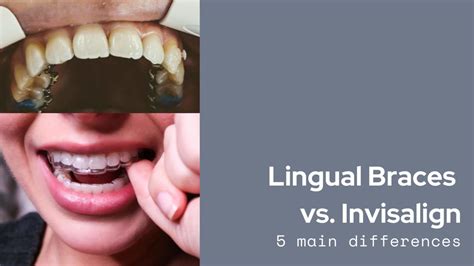 5 Main Differences Between Invisalign And Lingual Braces Modern