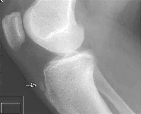 Radiograph Of A 12 Year Old Boy With Osgood Schlatter Disease Note The