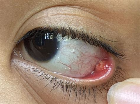 Stye In Eye Stye Causes Symptoms And Treatment Often It Is The