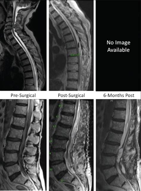 Iatrogenic Spinal Hematoma As A Complication Of Lumbar Puncture What