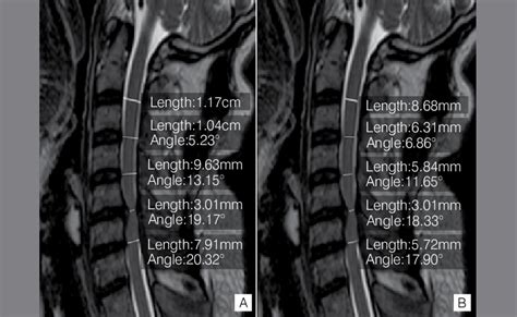 T2 Weighted Sagittal Mri Cuts Showing The Dvc A And Dsc B