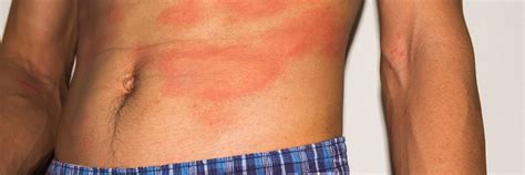 Red Rash Symptoms Causes And Treatment
