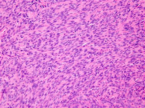 Pathology Outlines Myoepithelioma Myoepithelial Carcinoma Mixed Tumor