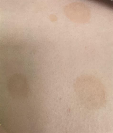 Weird Circle Patches Of Discolored Skin Near My Sons Chest Please