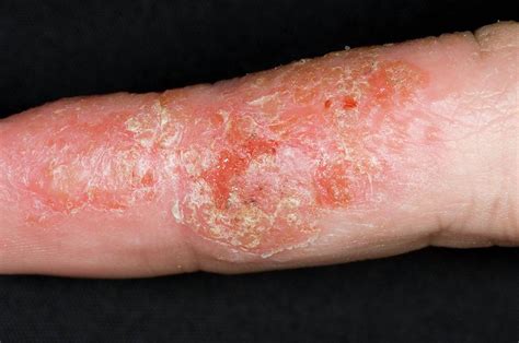 Eczema On The Finger Photograph By Dr P Marazziscience Photo Library