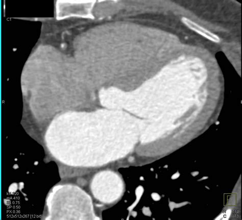 Coronary Cta With Evidence Of Outpouching Of Left Ventricle Represent