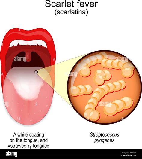 Scarlet Fever Symptoms Of Scarlatina Mouth With White Coating On The