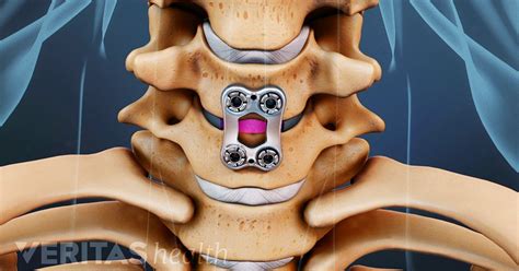 Artificial Disc Vs Anterior Cervical Discectomy And Fusion