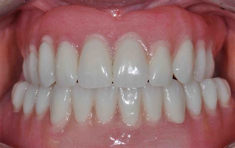 Denture Impression Border Molding - Lee Ann Brady DMD
