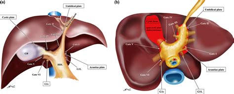 Systematic Extrahepatic Glissonean Pedicle Isolation For Anatomical