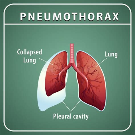 Pneumothorax Diagram With Collapsed Lung And Normal Lung Stock Vector