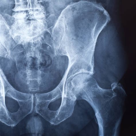 X Ray Of Osteoarthritis Hip