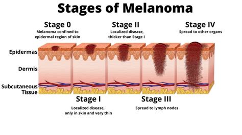 Malignant Melanoma Stage Dictates Prognosis Peoplebeatingcancer