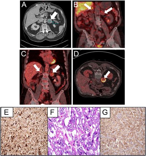 Imaging Studies And Surgical Pathology Of The Pheochromocytoma A Ct
