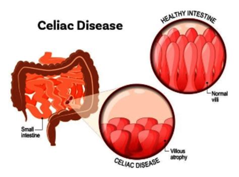 Celiac Disease Causes With Complete Guideline Healthpulls