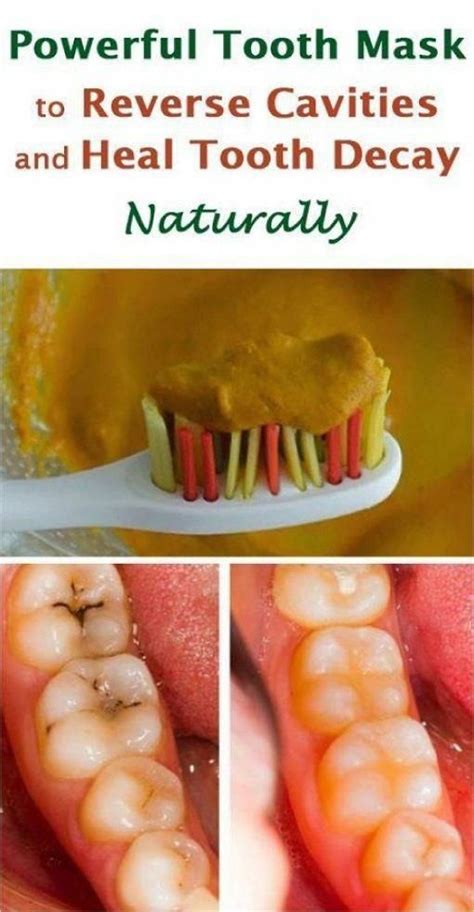How To Reverse Tooth Decay Ayurveda How To Heal Tooth Decay And
