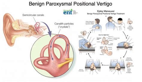 Benign Paroxysmal Positional Vertigo Clinical Characteristics Of