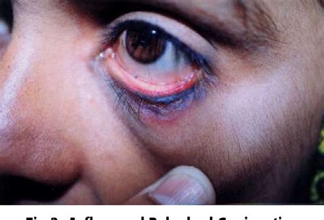 Figure 3 From Discoid Lupus Erythematosis Affecting The Eyelid With