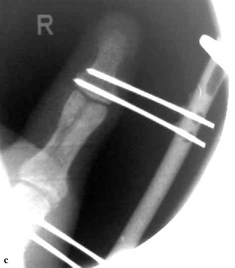 Figure 1 From A Simple External Fixator For Complex Finger Fractures