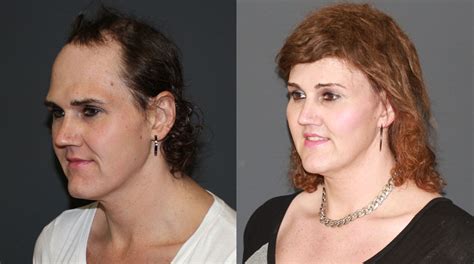 Facial Feminization Before And After Photo