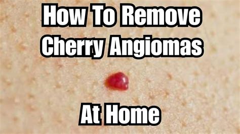 Diy Removing Cherry Angiomas At Home Youtube
