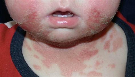Yeast Infection Heat Rash On Baby Neck How To Prevent And Treat