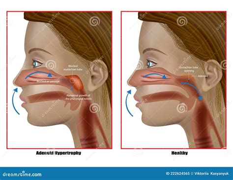 Adenoid Hypertrophy The Abnormal Growth Of The Pharyngeal Tonsils Adenoidectomy Eustachian