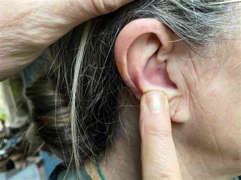 Pimple In Ear Causes And How To Get Rid Of Them Miracle Ear