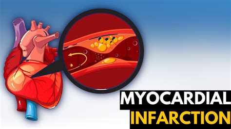 Myocardial Infarction Causes Signs And Symptoms Diagnosis And