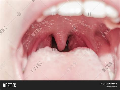 Larynx Throat Glands Tongue Viral Lingitis Inflammation Of Tonsils
