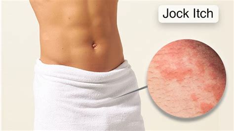 Jock Itch Jock Itch Causes Symptoms Amp Treatments Photos