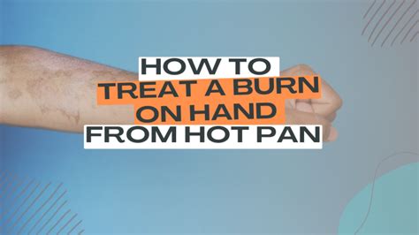 How To Treat A Burn On Hand From Hot Pan Using Household Things