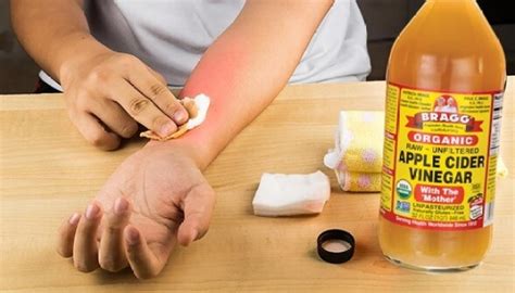 How To Get Rid Of Hives Fast At Home Health Beauty Aid