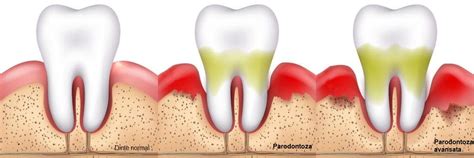 Ce Este Parodontoza Cum Se Manifesta Si Cum Se Trateaza Miko Dental