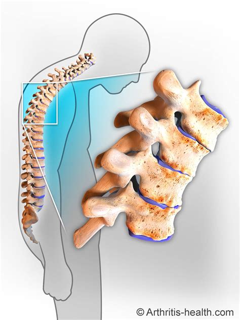 Ankylosing Spondylitis As Is A Type Of Arthritis That Primarily