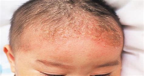 Infant Seborrheic Dermatitis Scalp Treatment Symptoms And Causes