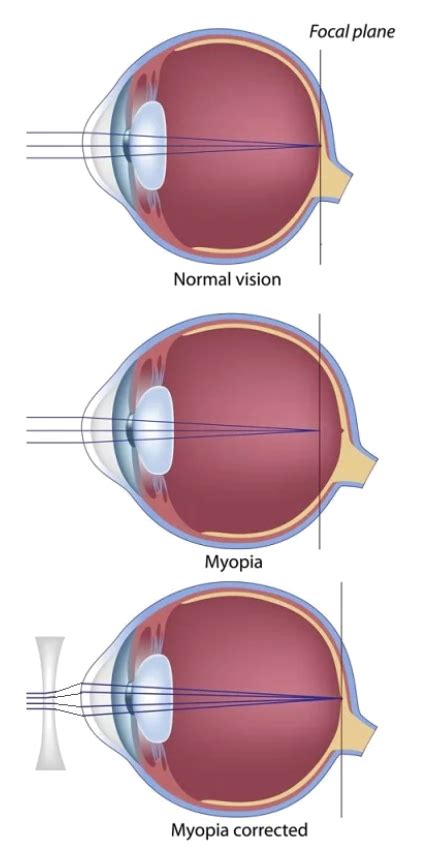Myopia Nearsightedness Look And See Eyecare